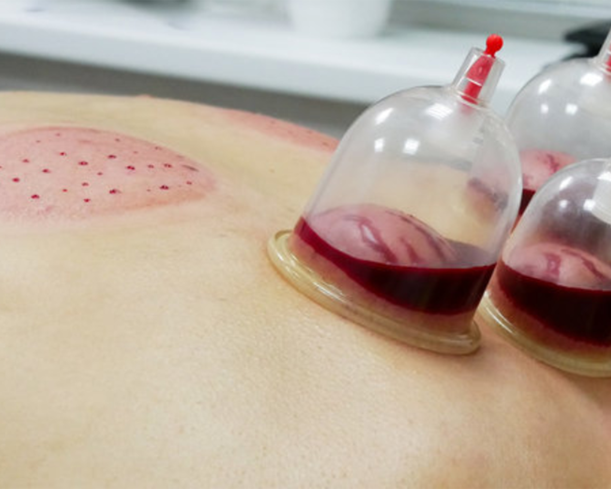 hijama
